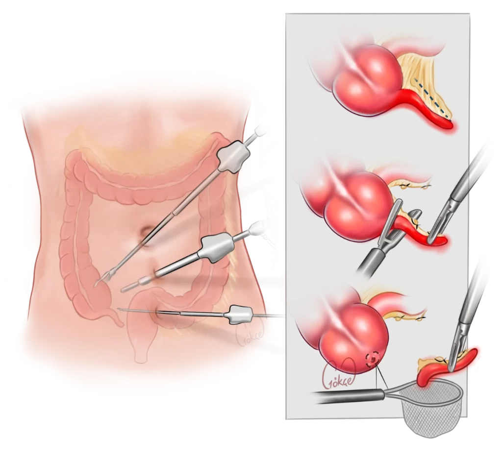 appendectomy laparoscopic