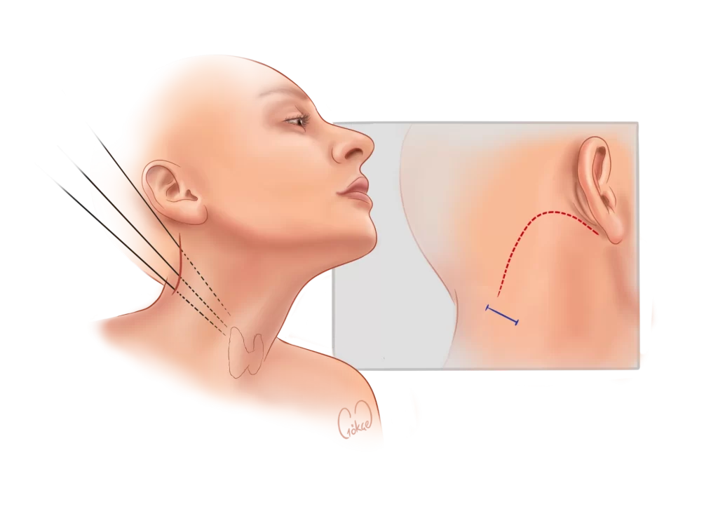 auricular thyroidectomy