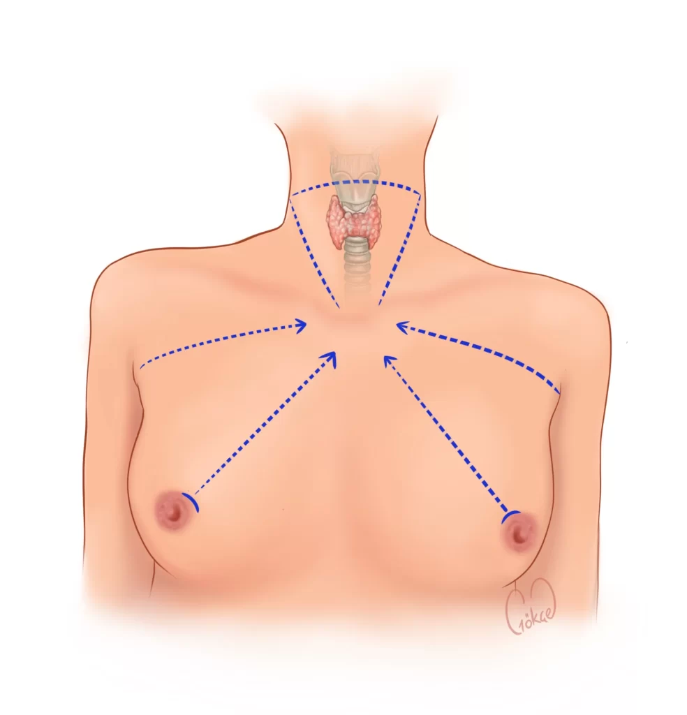 axillary thyroidectomy