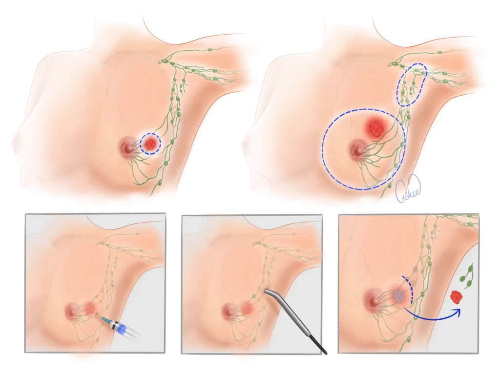 breast cancer