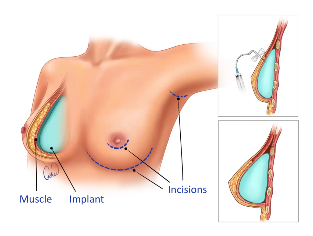 breast implant