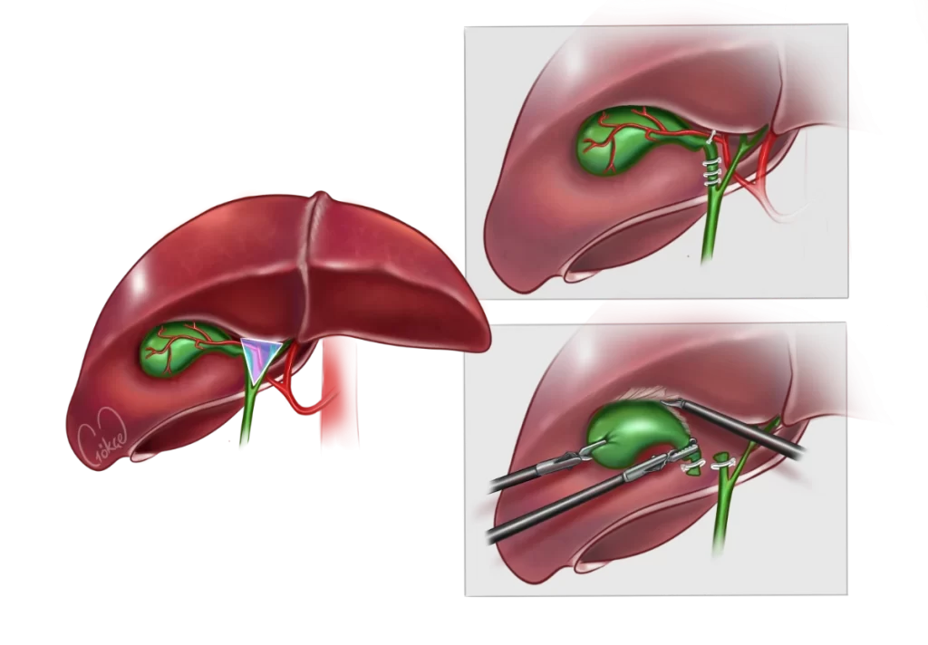 cholecistectomy