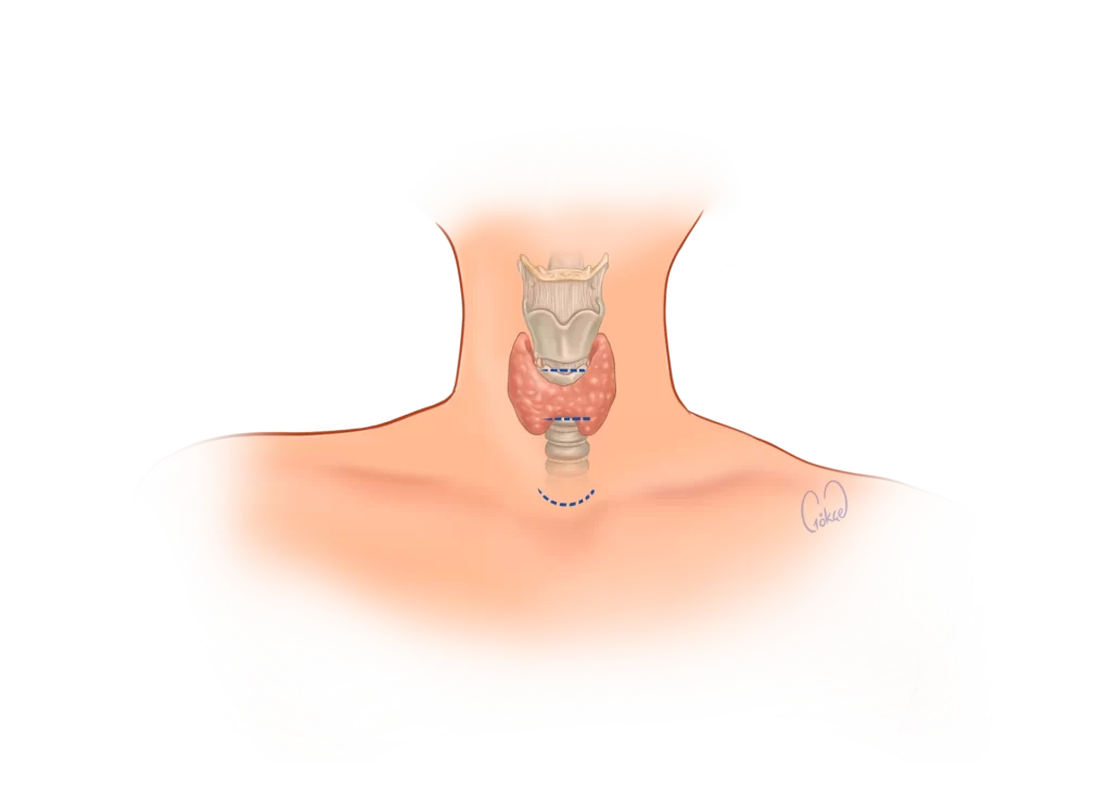 incisions