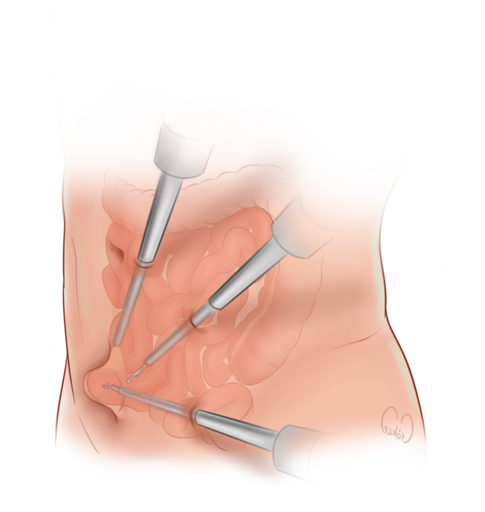 laparoscopic hernia repair