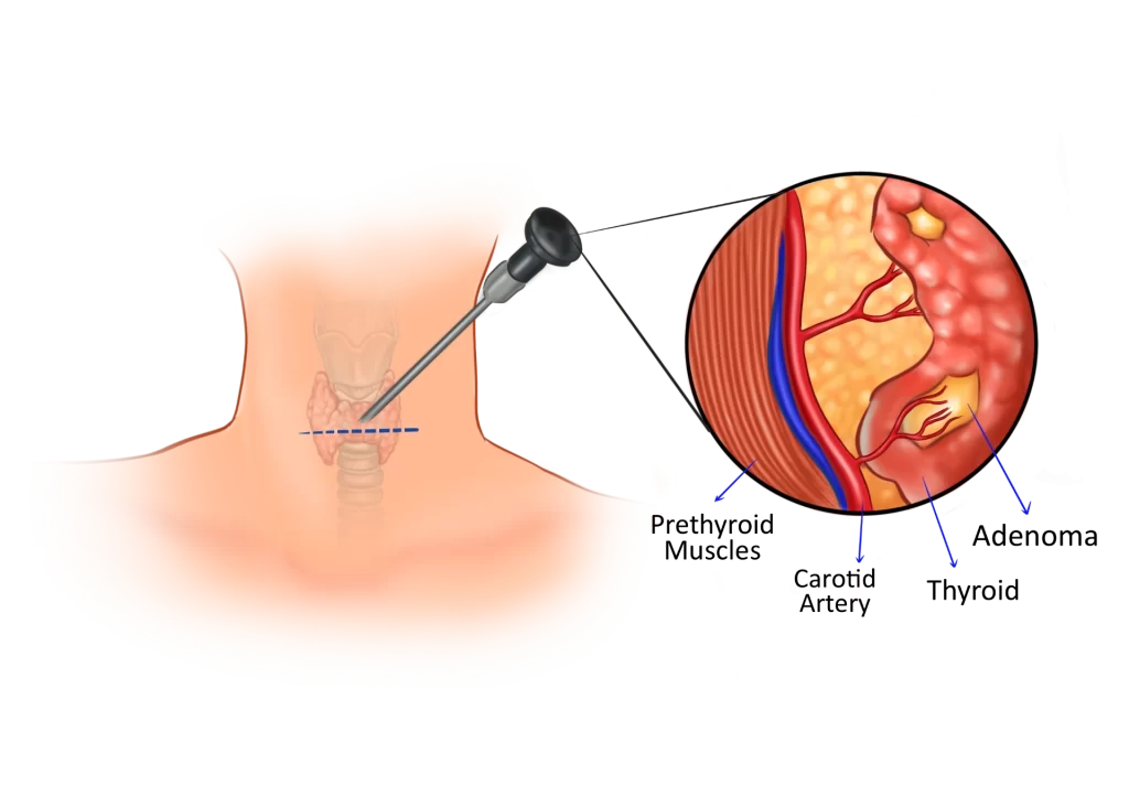 minimally invasive