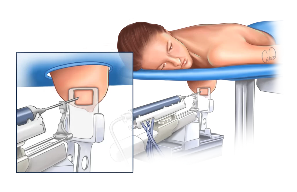 needle biopsy