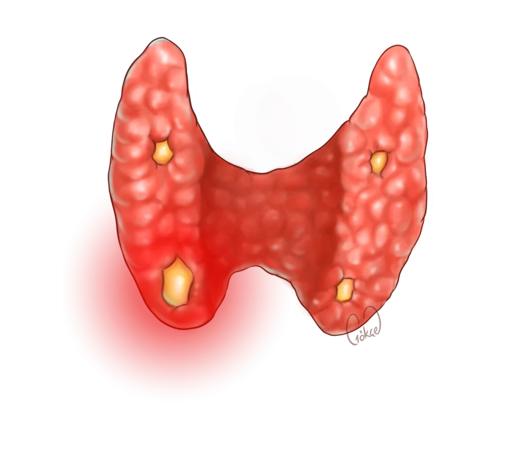 parathyroid adenoma