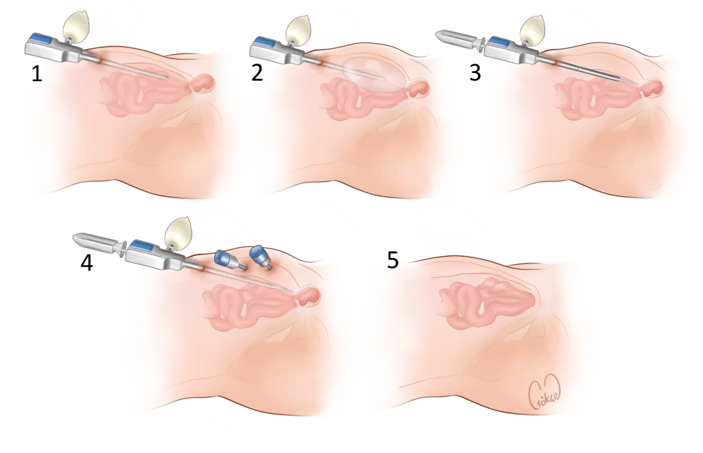 tep horizontal stages