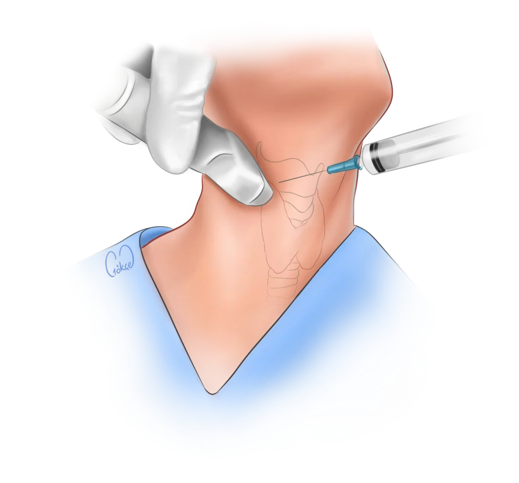 thyroid biopsy