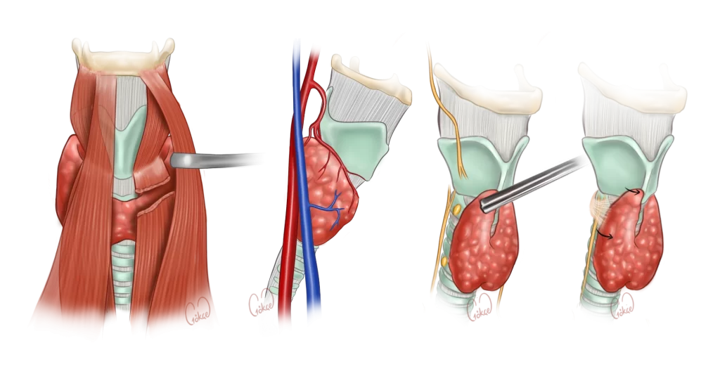 thyroidectomy