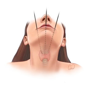 transoral biopsy