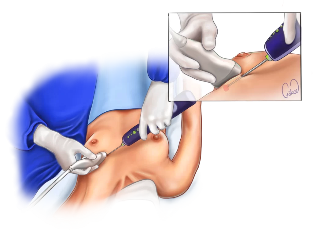 usg biopsy