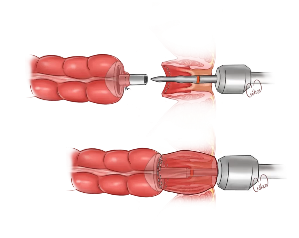 anastomosis