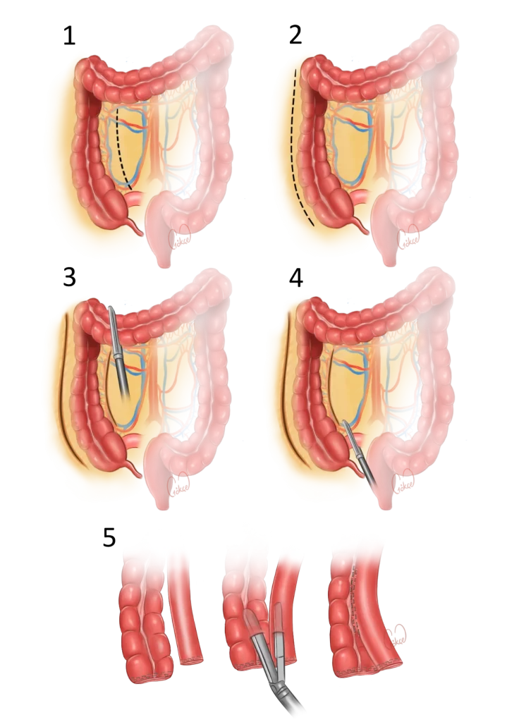 dissection steps