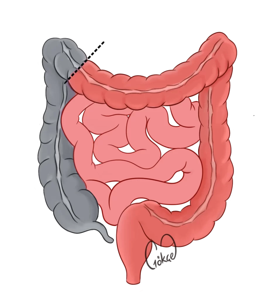 resection1