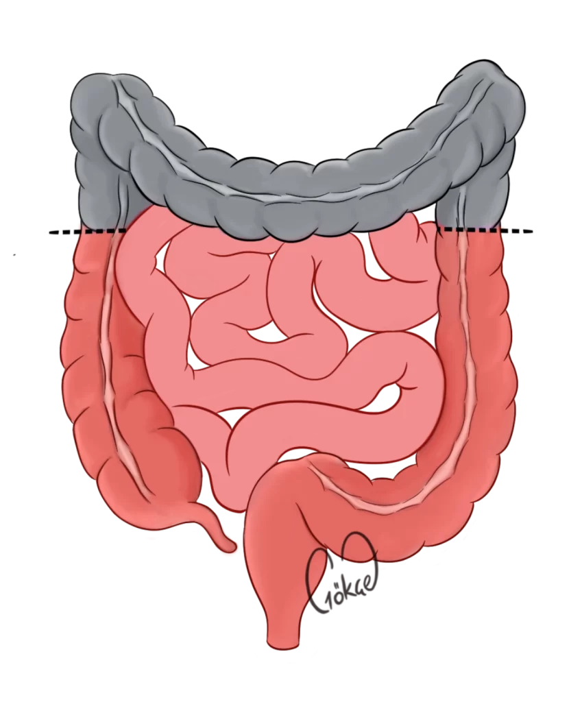 resection2