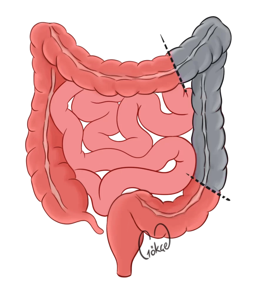 resection3