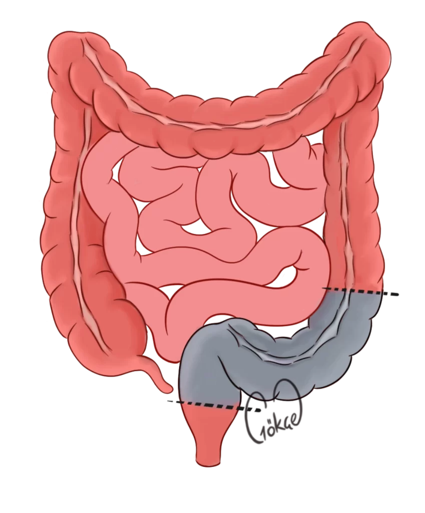 resection4
