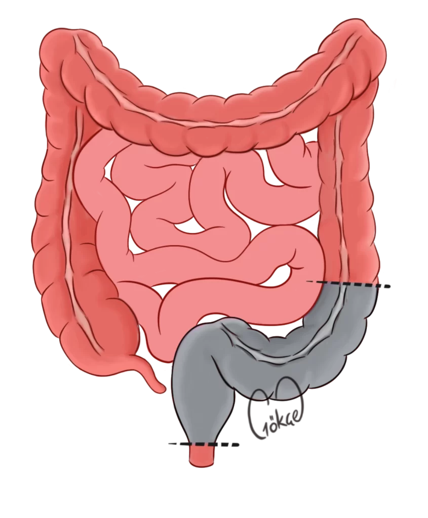 resection5
