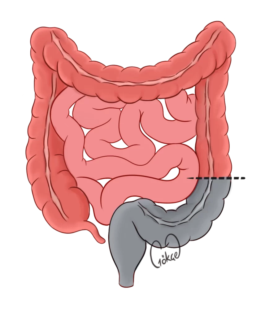 resection6
